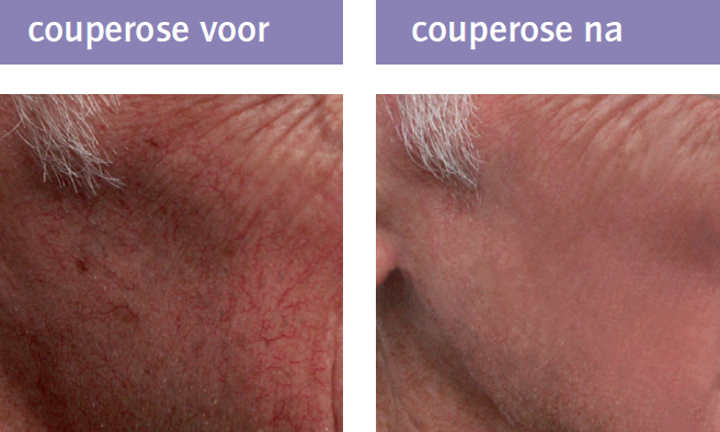 Couperose IPL therapie naturalskin