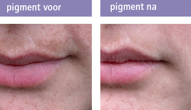 Pigmentvlek IPL therapie Naturalskin